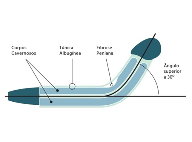 Arte explicativa sobre a anatomia do pênis em função de uma fibrose peniana.