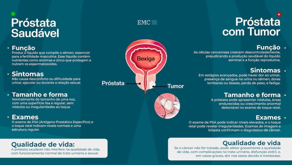 Representação ilustrativa de próstata saudável e próstata com cancro.