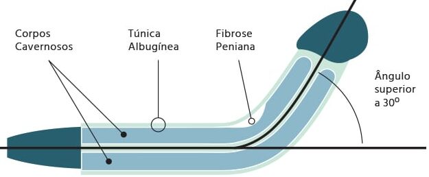 Infográfico mostra pénis curvado com a túnica albugínea afetado pelas fibroses da Doença de Peyronie